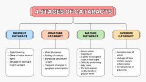 4 stages of Cataracts